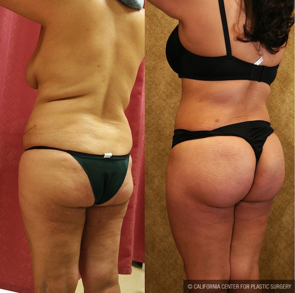 Buttock Lift/Augmentation Before & After Patient #12749