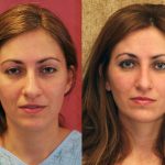 Neck & Face Liposuction Before & After Patient #12811