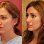 Neck & Face Liposuction Before & After Patient #12811