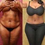 African American Tummy Tuck (Abdominoplasty) Before & After Patient #12820