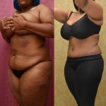 African American Tummy Tuck (Abdominoplasty) Before & After Patient #12820