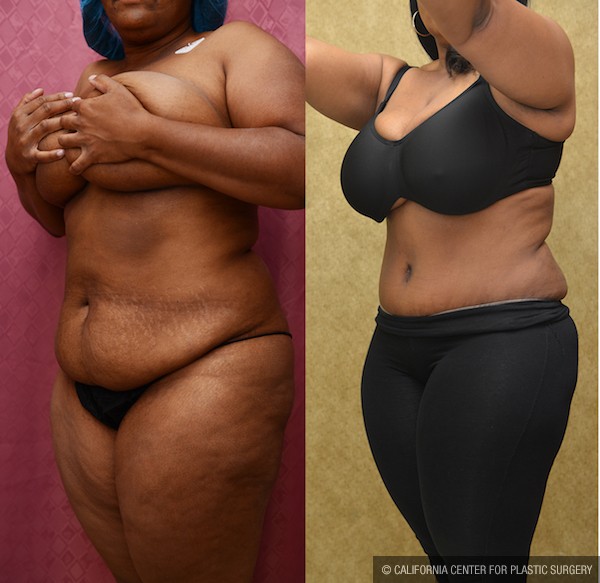 African American Tummy Tuck (Abdominoplasty) Before & After Patient #12820