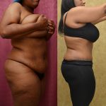 African American Tummy Tuck (Abdominoplasty) Before & After Patient #12820