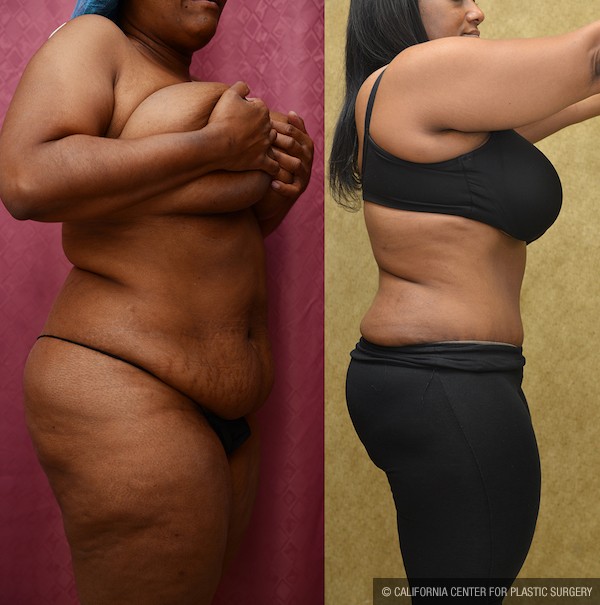 African American Tummy Tuck (Abdominoplasty) Before & After Patient #12820