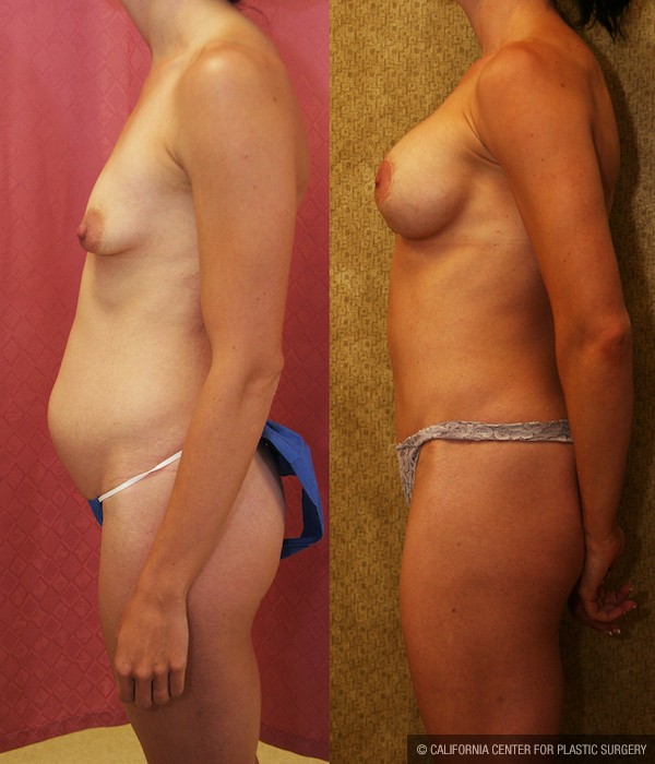 Tummy Tuck (Abdominoplasty) Medium Size Before & After Patient #12824