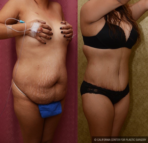 Tummy Tuck (Abdominoplasty) Medium Size Before & After Patient #12828