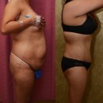 Tummy Tuck (Abdominoplasty) Medium Size Before & After Patient #12828