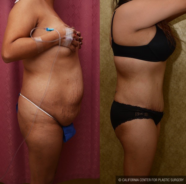 Tummy Tuck (Abdominoplasty) Medium Size Before & After Patient #12828
