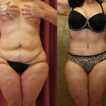 Tummy Tuck (Abdominoplasty) Medium Size Before & After Patient #12832