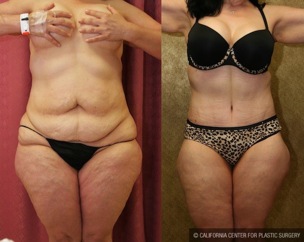 Tummy Tuck (Abdominoplasty) Medium Size Before & After Patient #12832