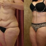 Tummy Tuck (Abdominoplasty) Medium Size Before & After Patient #12832