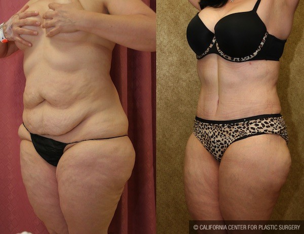 Tummy Tuck (Abdominoplasty) Medium Size Before & After Patient #12832