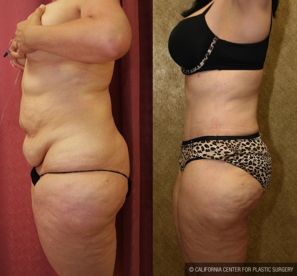 Tummy Tuck (Abdominoplasty) Medium Size Before & After Patient #12832