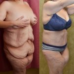 Tummy Tuck (Abdominoplasty) Plus Size Before & After Patient #12840