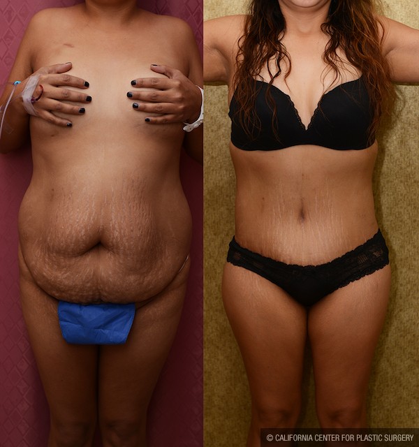 Tummy Tuck Plus Size Before & After Patient #12844