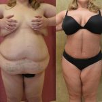 Tummy Tuck (Abdominoplasty) Plus Size Before & After Patient #12853