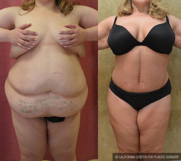Tummy Tuck Plus Size Before & After Patient #12853