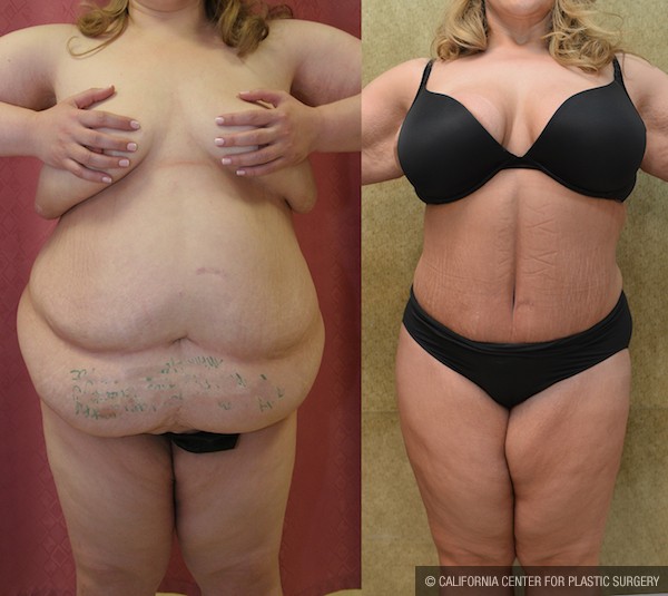 Tummy Tuck (Abdominoplasty) Plus Size Before & After Patient #12853