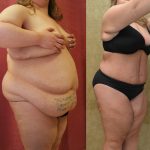 Tummy Tuck (Abdominoplasty) Plus Size Before & After Patient #12853