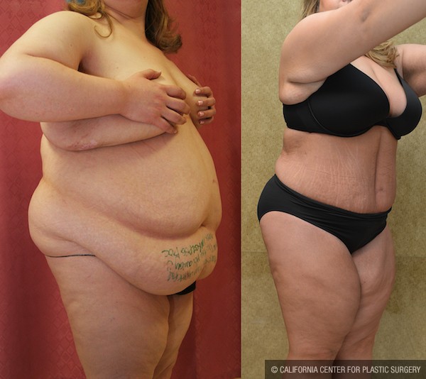 Tummy Tuck (Abdominoplasty) Plus Size Before & After Patient #12853