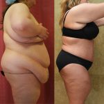 Tummy Tuck (Abdominoplasty) Plus Size Before and After Photos