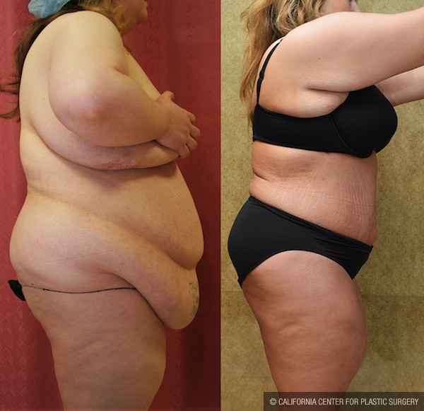 Tummy Tuck (Abdominoplasty) Plus Size Before & After Patient #12853