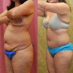 Tummy Tuck (Abdominoplasty) Small Size Before & After Patient #12861