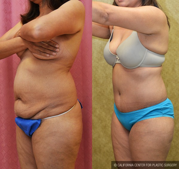 Tummy Tuck (Abdominoplasty) Small Size Before & After Patient #12861