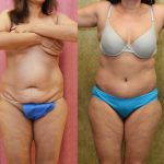 Tummy Tuck (Abdominoplasty) Small Size Before & After Patient #12861