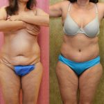 Tummy Tuck (Abdominoplasty) Small Size Before & After Patient #12861