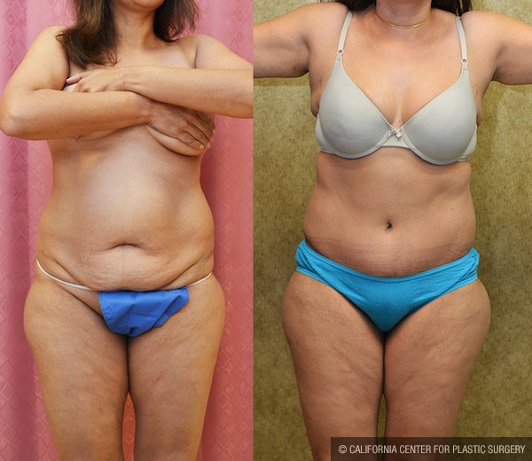 Tummy Tuck (Abdominoplasty) Small Size Before & After Patient #12861