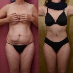 Tummy Tuck (Abdominoplasty) Small Size Before & After Patient #12865