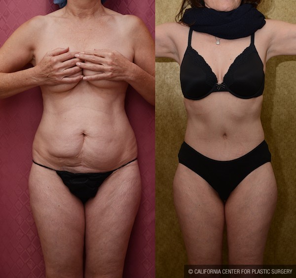 Tummy Tuck (Abdominoplasty) Small Size Before & After Patient #12865