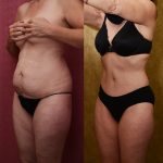 Tummy Tuck (Abdominoplasty) Small Size Before & After Patient #12865