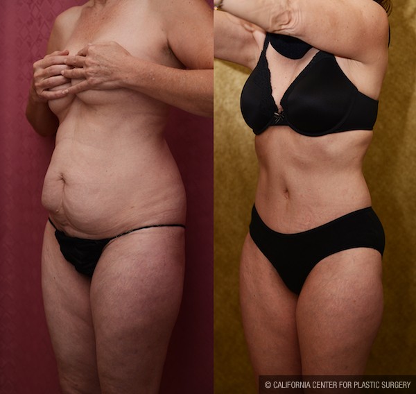 Tummy Tuck (Abdominoplasty) Small Size Before & After Patient #12865