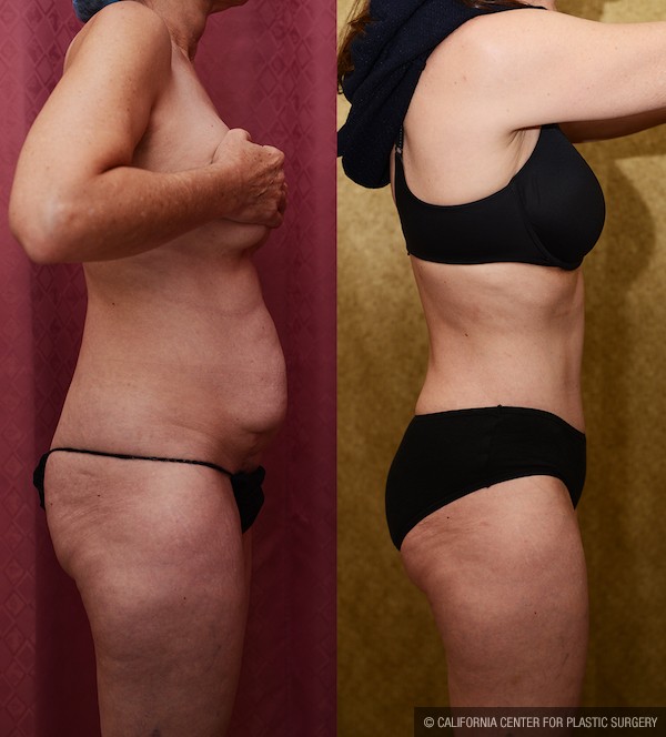 Tummy Tuck (Abdominoplasty) Small Size Before & After Patient #12865
