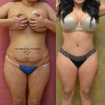 Tummy Tuck (Abdominoplasty) Small Size Before & After Patient #12869