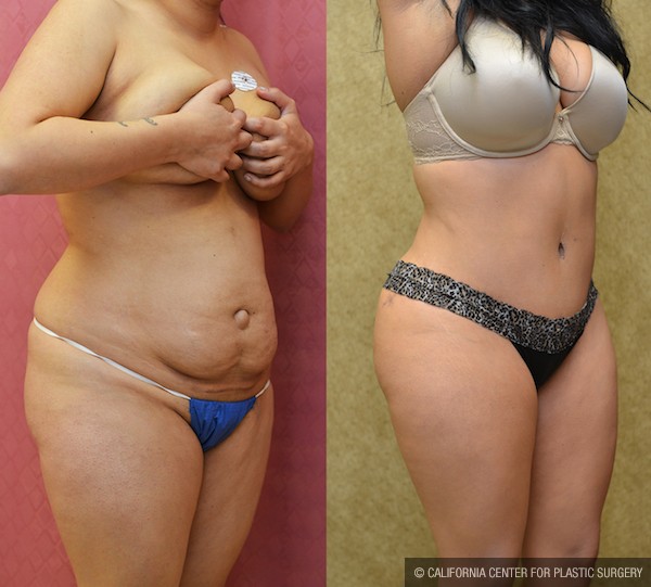 Tummy Tuck (Abdominoplasty) Small Size Before & After Patient #12869