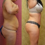 Tummy Tuck (Abdominoplasty) Small Size Before & After Patient #12869