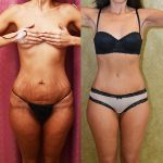 Tummy Tuck (Abdominoplasty) Small Size Before & After Patient #12873