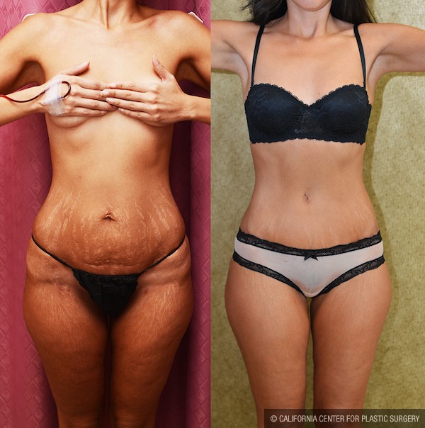Tummy Tuck Small Size Before & After Patient #12873