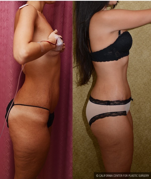 Tummy Tuck (Abdominoplasty) Small Size Before & After Patient #12873