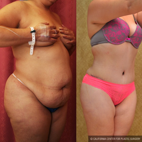 Tummy Tuck (Abdominoplasty) Plus Size Before & After Patient #12849