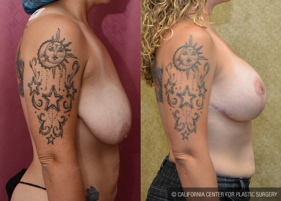 Breast Lift - Full Before & After Patient #12735