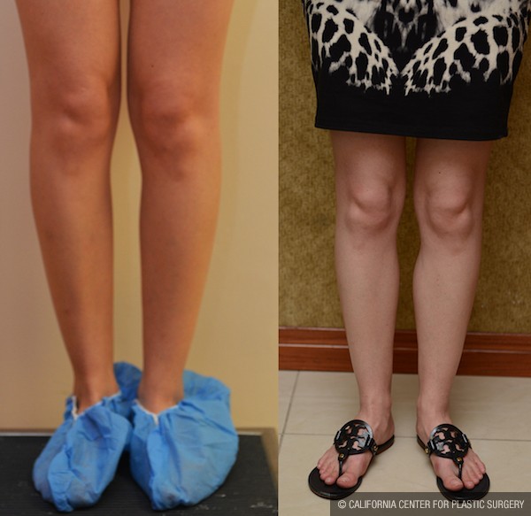 Calf Augmentation Before & After Patient #12754