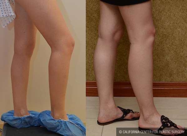 Calf Augmentation Before & After Patient #12754