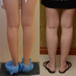 Calf Augmentation Before & After Patient #12754