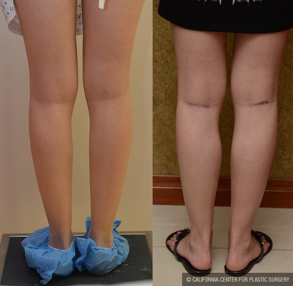 Calf Augmentation Before & After Patient #12754