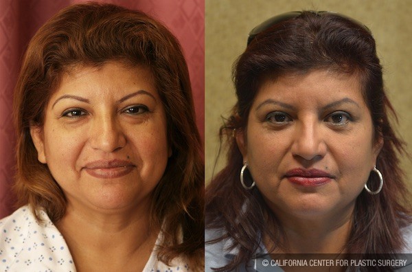 Eyelid (Blepharoplasty) Before & After Patient #12758