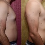 Male gynecomastia (breast) reduction Before & After Patient #12769